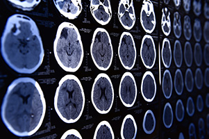 Stroke/Tramatic Brain Injury (TBI)